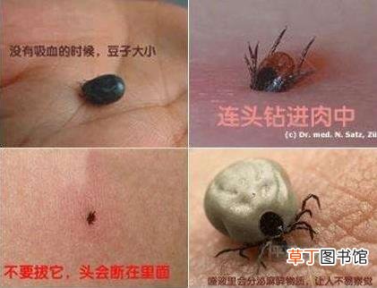 头上长虱子怎么去除 去虱子和虱子卵的有效方法