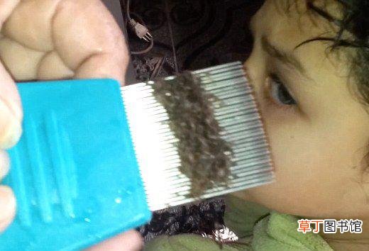 头上长虱子怎么去除 去虱子和虱子卵的有效方法