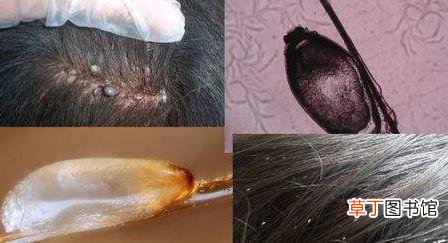 头上长虱子怎么去除 去虱子和虱子卵的有效方法