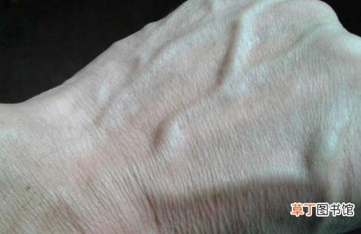 手上青筋说明身体有湿气 不同部位青筋显示不同问题