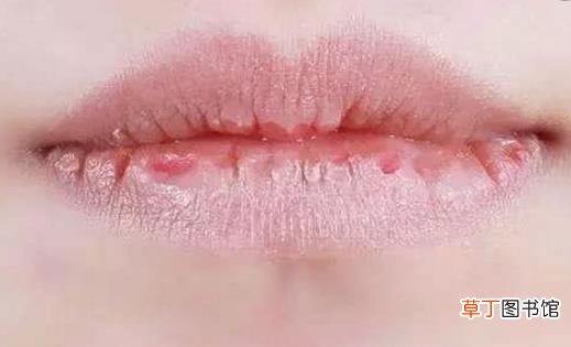 嘴唇干裂的原因 嘴唇干裂治疗小偏方