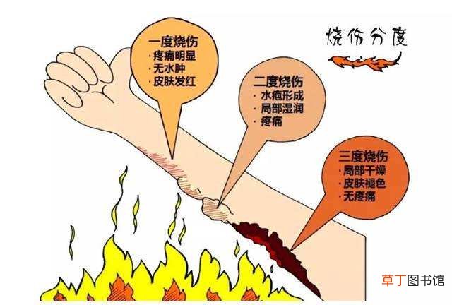 烧伤感染后可能会出现哪些问题 请问小面积烧伤怎么处理
