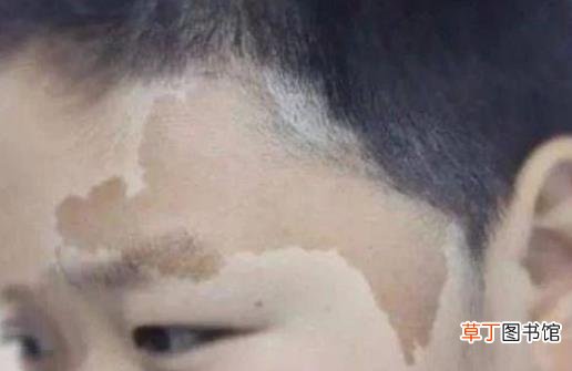 身上长胎记竟暗藏杀机 小心胎记可能是疾病信号