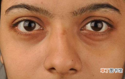 黑眼圈不仅是因为肾虚 黑眼圈透露你身体的健康问题