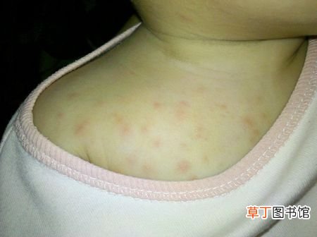 冬季婴儿热痱子怎么治 新生儿冬天热痱子快速治理