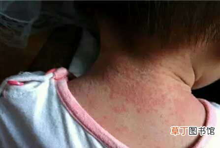 冬季婴儿热痱子怎么治 宝宝冬天身上长痱子怎么办