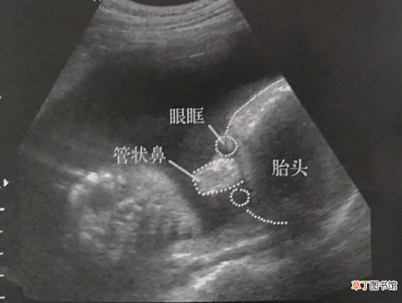 原来超声只能看见宝宝这些 独眼喙鼻畸形