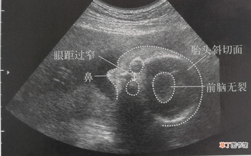 原来超声只能看见宝宝这些 独眼喙鼻畸形