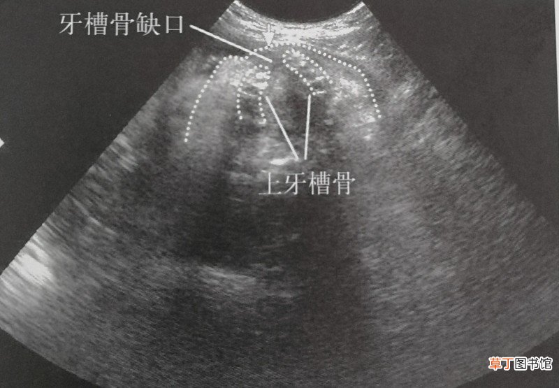 原来超声只能看见宝宝这些 独眼喙鼻畸形