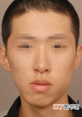 打瘦脸针的三大副作用 打瘦脸针有什么危害