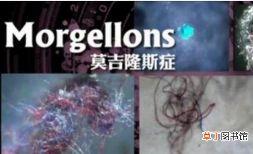 转基因莫吉隆斯症,五彩纤维从身体长出/虫子在皮肤下蠕动