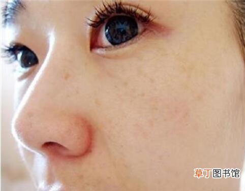 怎么淡化脸颊两边的斑