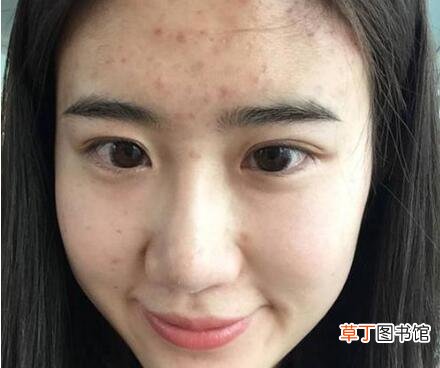 美容院清痘会留下痘印吗