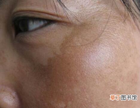 黄褐斑怎么去