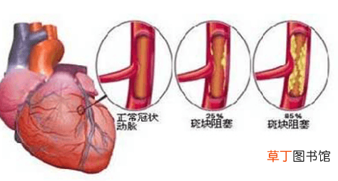 心肌缺血中成药-心肌缺血用那些中成药