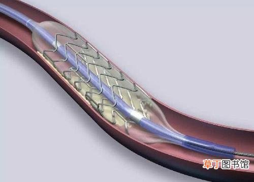支架手术后寿命是多久-支架手术后能活多久