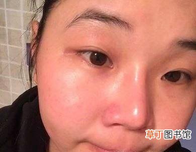 爆晒过后需要如何护肤呢？