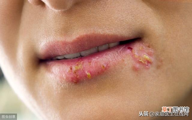 唇疱疹怎么快速消除 嘴唇长泡是上火引起的