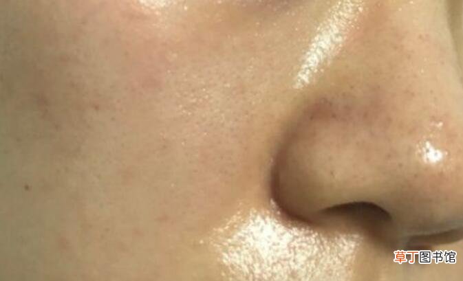 如何改善脸上粗大毛孔