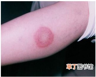 什么叫红斑狼疮-红斑狼疮是什么