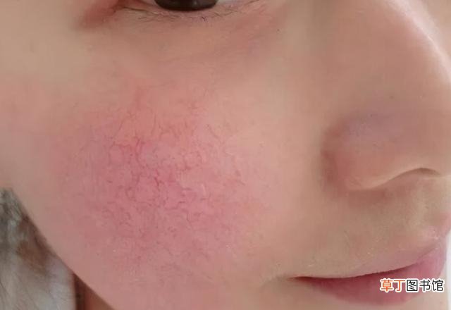 脸颊红血丝如何解决 脸部红血丝要如何改善