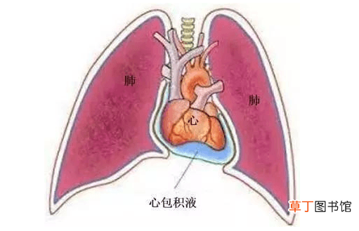 心包积液原因-心包积液怎么回事