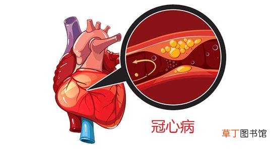 冠心病有哪些症状表现-冠心病有什么症状表现