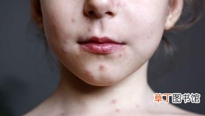 5个生活小妙招告别过敏皮肤 面部皮肤过敏怎么办