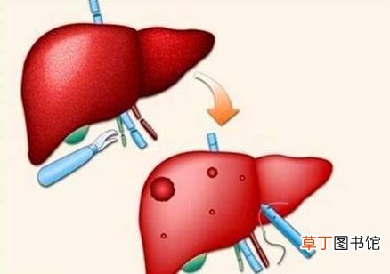 肝囊肿最佳治疗方法-最佳治疗肝囊肿的方法是什么