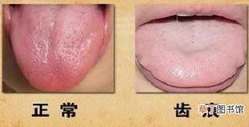 舌头有齿痕是怎么回事-为什么舌头上会有齿痕