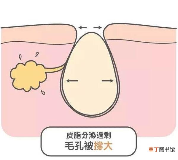 改善脸部毛孔粗大方法