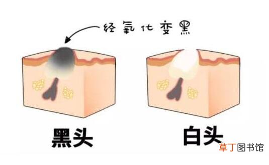 鼻子上的黑头直接挤掉可以吗
