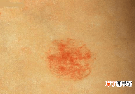 血管瘤的危害有哪些-治疗血管瘤最好最好的方法有哪些