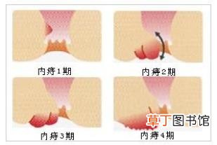 什么是痔疮-痔疮是什么