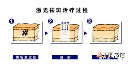 做了激光祛斑后多久可以洗脸