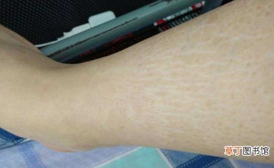 肥胖纹是爱美女士心里的痛 肥胖纹该怎么做才能去除