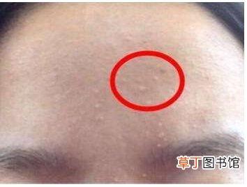额头老是长闭口是什么原因