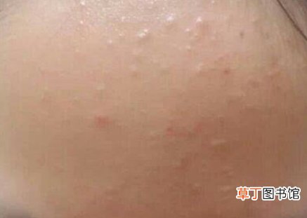 用护肤品起小米粒疙瘩怎么回事