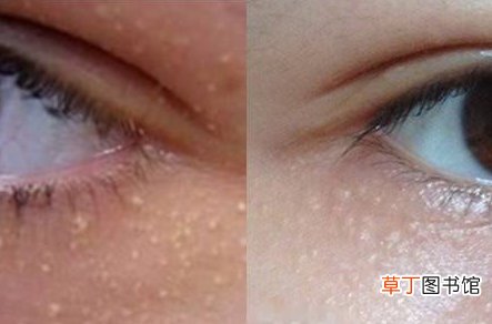 用护肤品起小米粒疙瘩怎么回事