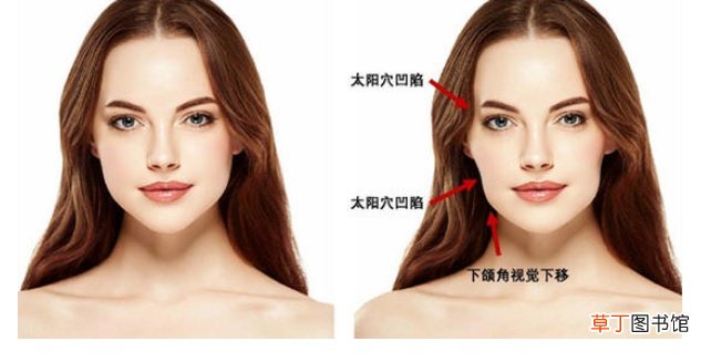 脸颧沟怎么消除
