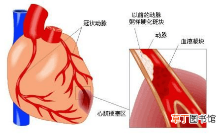 心肌缺血会自愈吗-心肌缺血可不可以自愈