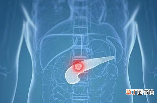 胰腺炎死亡率高达70％ 胰腺炎发病给人体发出的警报