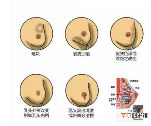 乳腺增生的症状有哪些-乳腺增生的症状有哪些