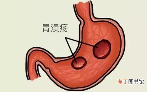 胃溃疡多久能好-胃溃疡多久可以愈合