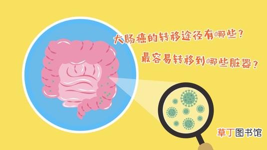 结肠癌转移途径-结肠癌转移途径有哪些
