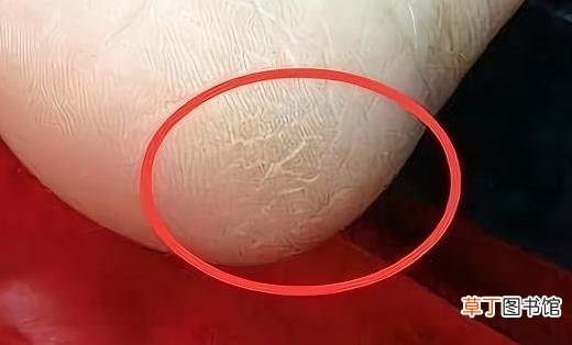 手脚脱皮的原因 八种方法预防脚脱皮