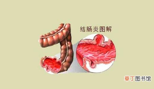 治慢性结肠炎的中成药-治慢性结肠炎最佳中成药推荐