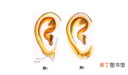 耳垂里面长了个硬疙瘩什么原因-耳垂里面长了个硬疙瘩怎么回事