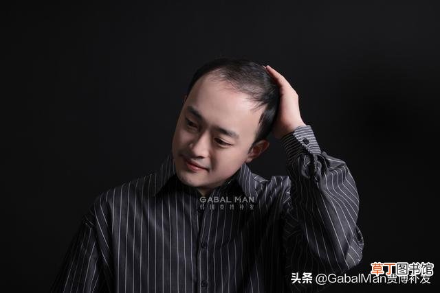 改善发际线高的5中方法 男人发际线高怎么改善