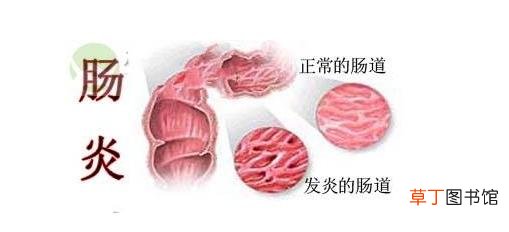直肠炎症状有哪些症状-直肠炎有什么症状体现